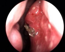 慢性鼻炎的發(fā)病原因？成都耳鼻喉醫(yī)院分析