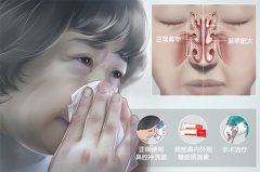 鼻甲肥大必須手術嗎？成都耳鼻喉醫院解答