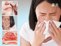 成都鼻炎會引起哪些癥狀？如何減少鼻炎發作？