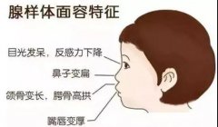孩子腺樣體肥大有哪些征兆？成都耳鼻喉科醫生解答